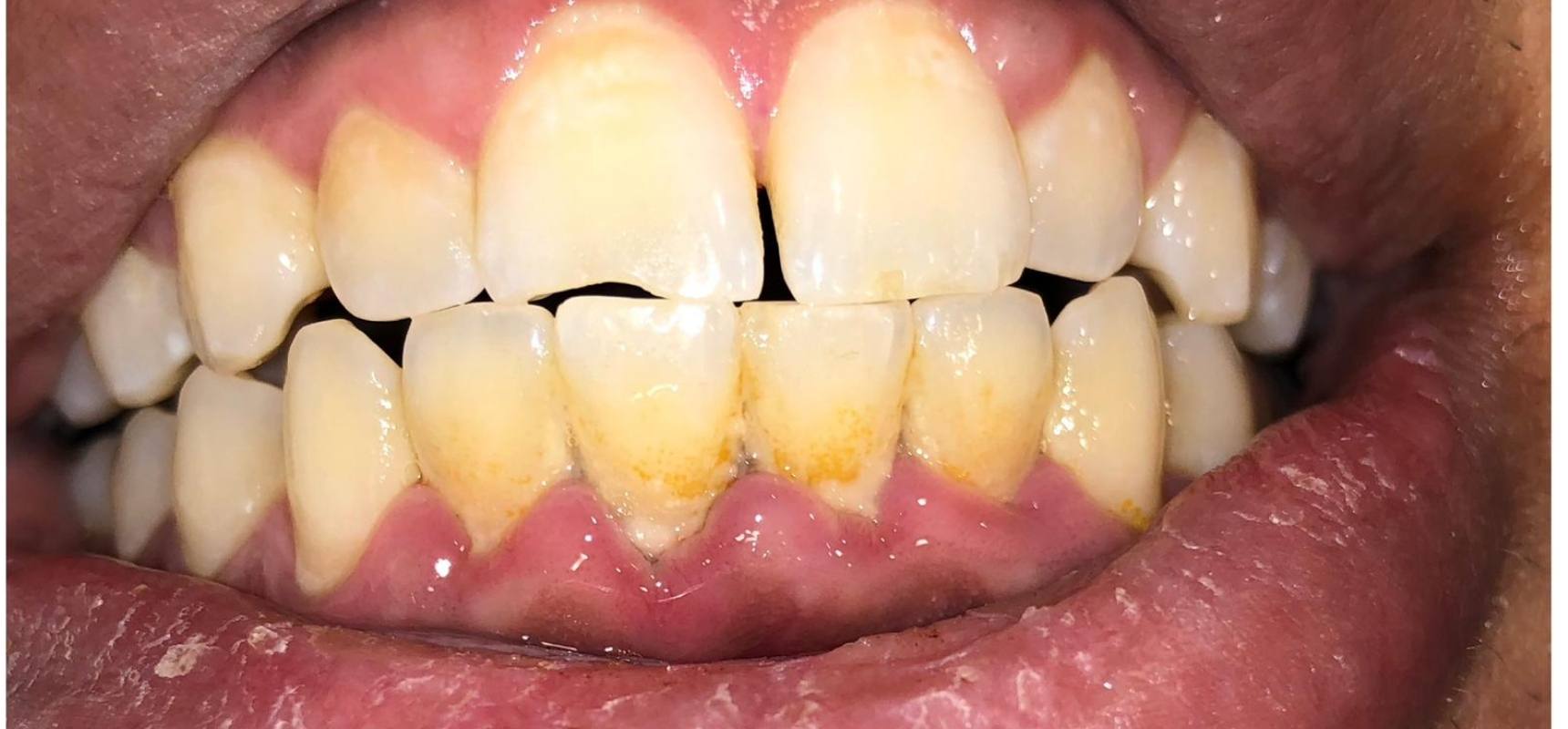 Before-Full mouth scaling and polishing