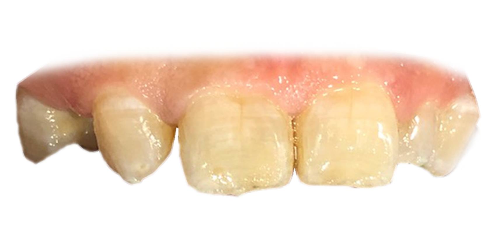 Before-Veneer to improve shape and colors of upper front teeth done 