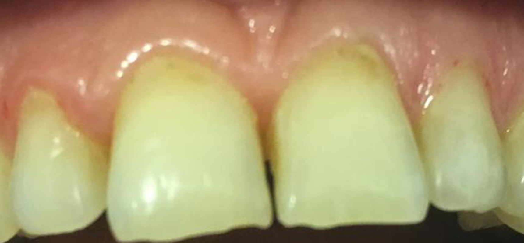 Before-Veneer Case