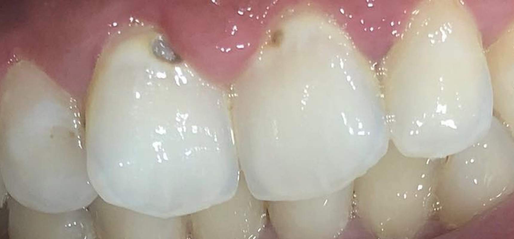Before-Composite filling after removal of decay.