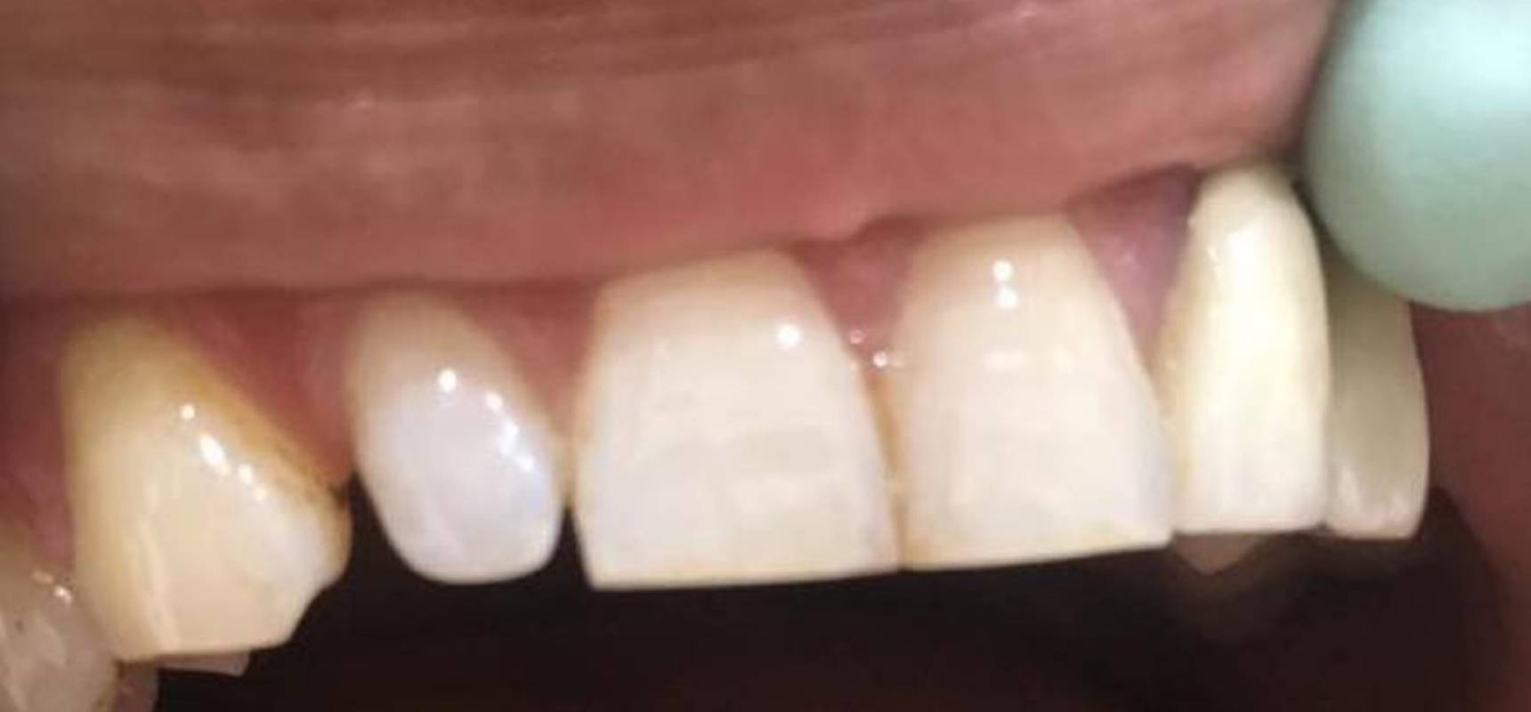 Before-Closing the spaces between the teeth with IMAX technology (German technology)