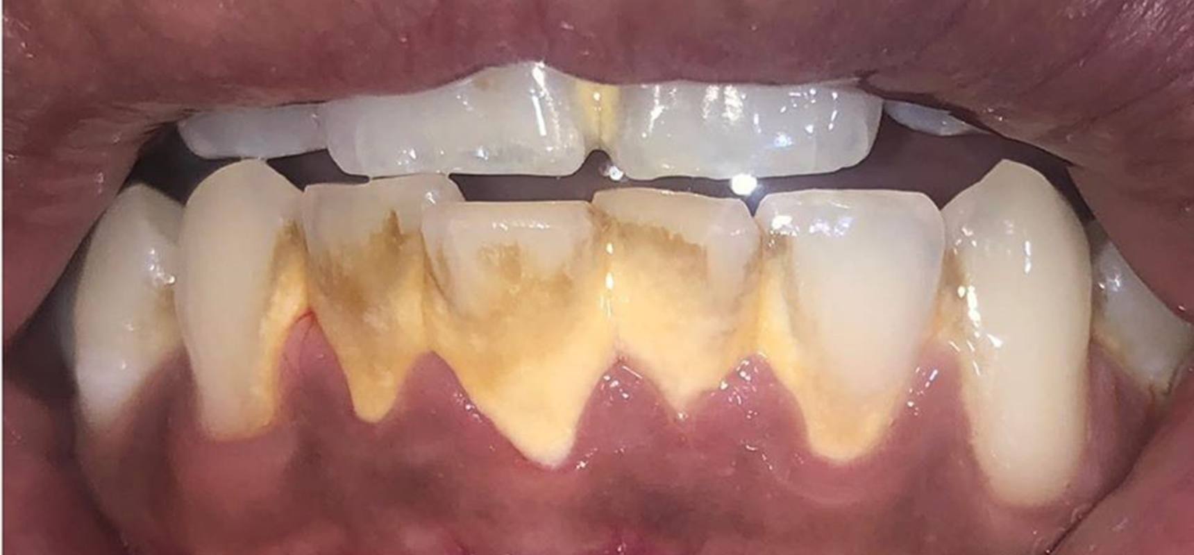 Before-Scaling and polishing