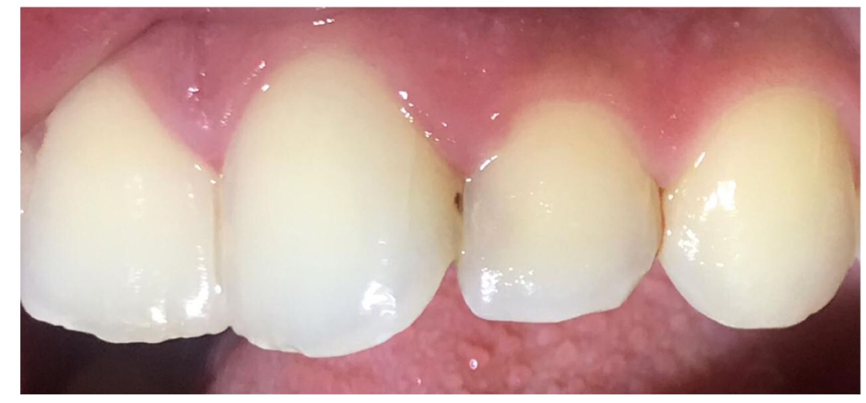 Before-Cosmetic fillings for the front teeth.