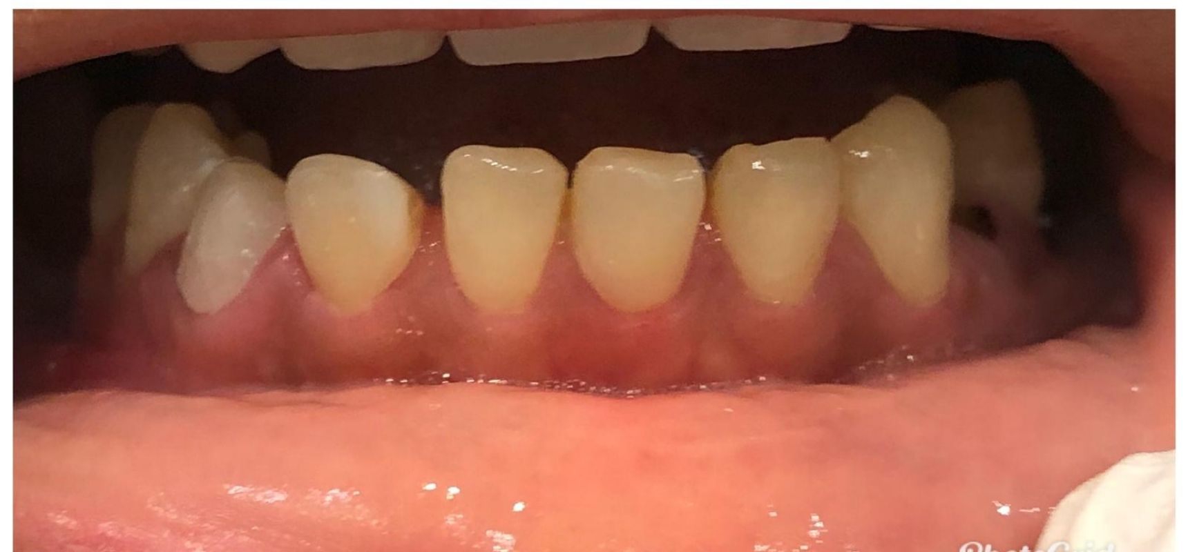 After-Filling & Root Canal Treatment