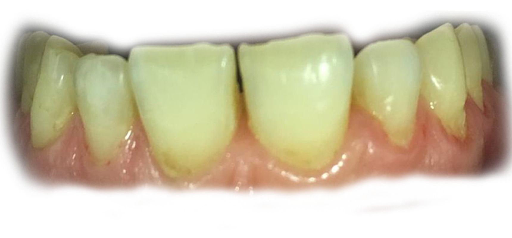 Before-Veneer case