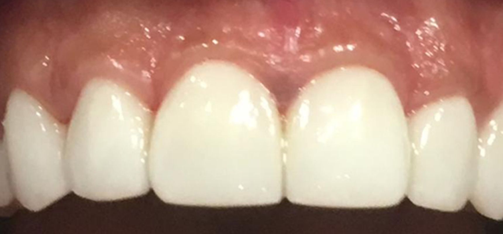 After-Veneer Case