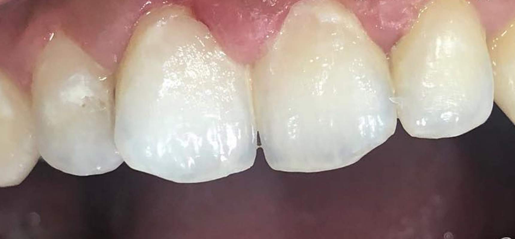 After-Composite filling after removal of decay.