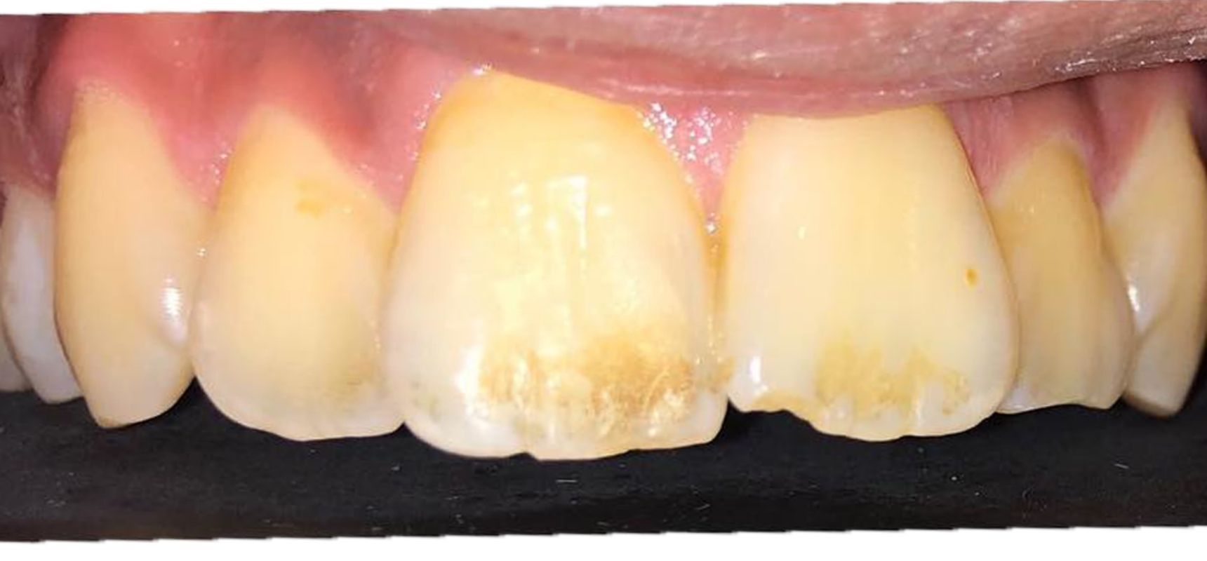 Before-Polishing of front teeth