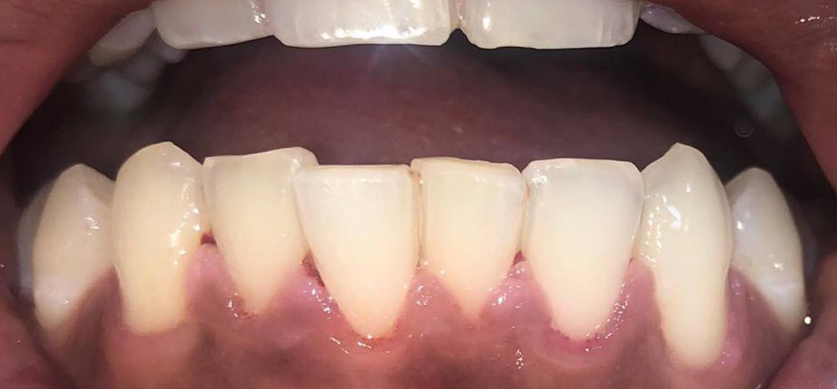 After-Scaling and polishing