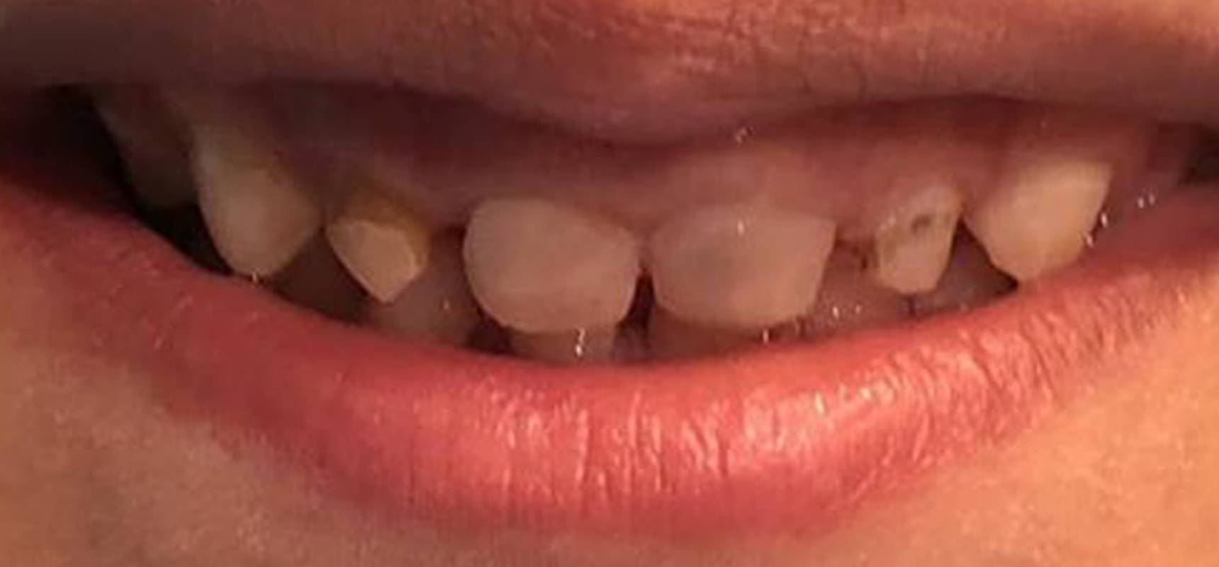 After-Esthetic Filling