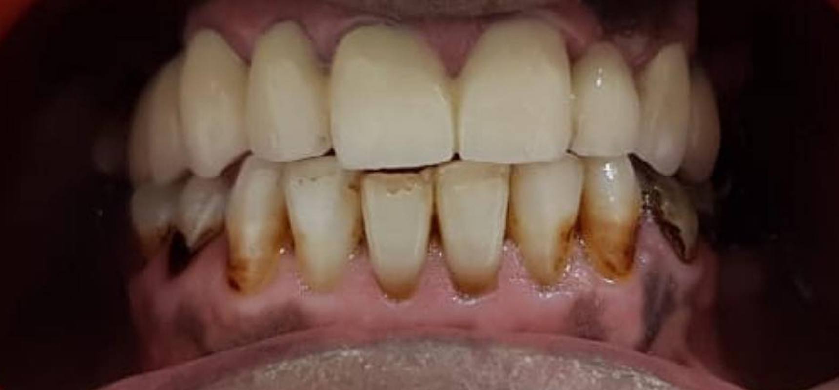 After-Fixed prosthodontic