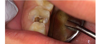 Before- child with filling