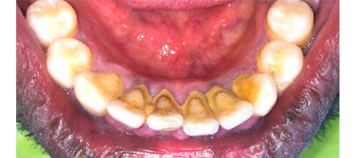 Before-Full mouth scaling and polishing
