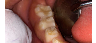 After- child with filling