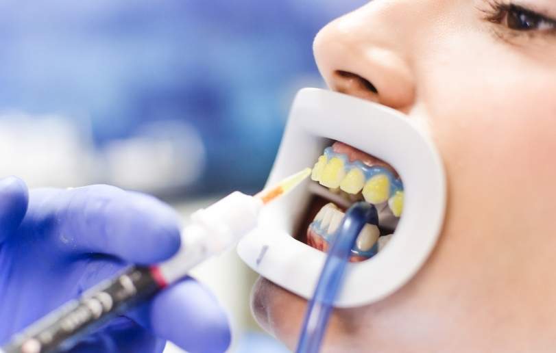 Teeth Whitening - Dr Sadiq Sharaf Dental Center