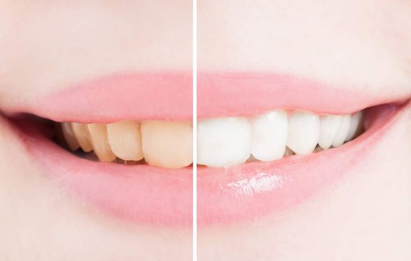 Teeth Whitening - Dr Sadiq Sharaf Dental Center